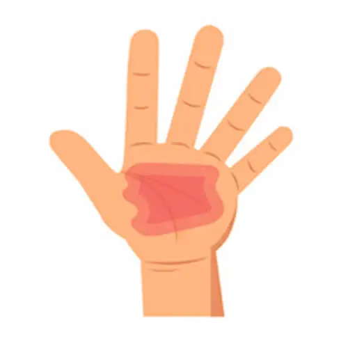 Gangrene Treatment In Hyderabad