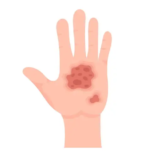 Gangrene Treatment In Hyderabad