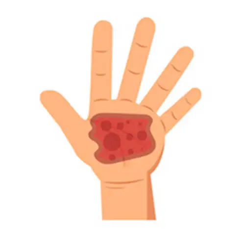 Gangrene Treatment In Hyderabad