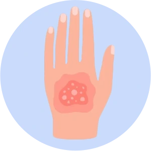 Gangrene Treatment In Hyderabad