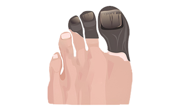 Gangrene Treatment In Hyderabad